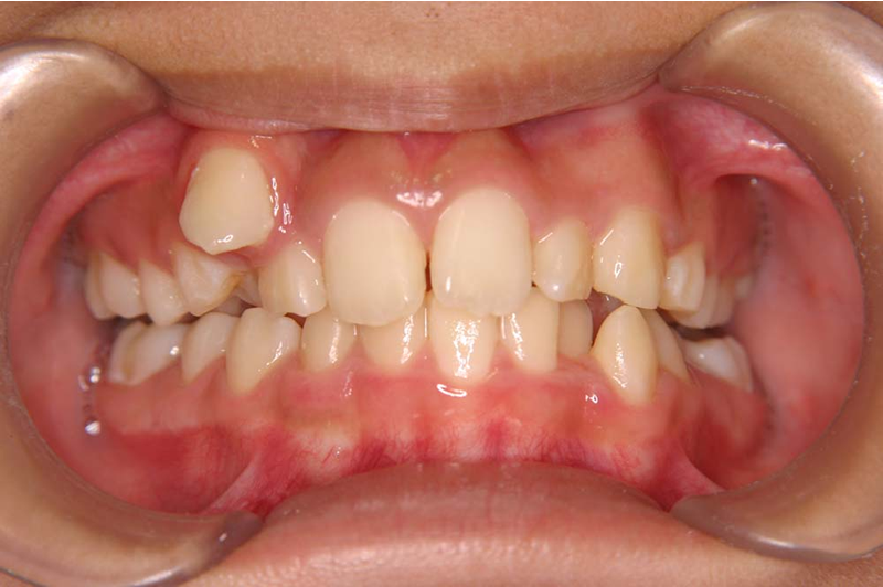 こんな歯並びは要注意 みやわき矯正歯科クリニック 宇部市 山口市